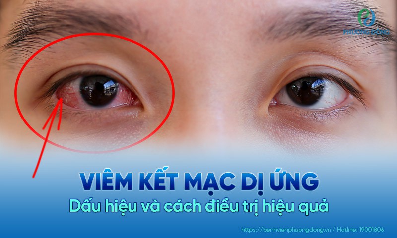 Thuốc Điều Trị Viêm Kết Mạc Dị Ứng Theo Mùa: Hướng Dẫn Toàn Diện