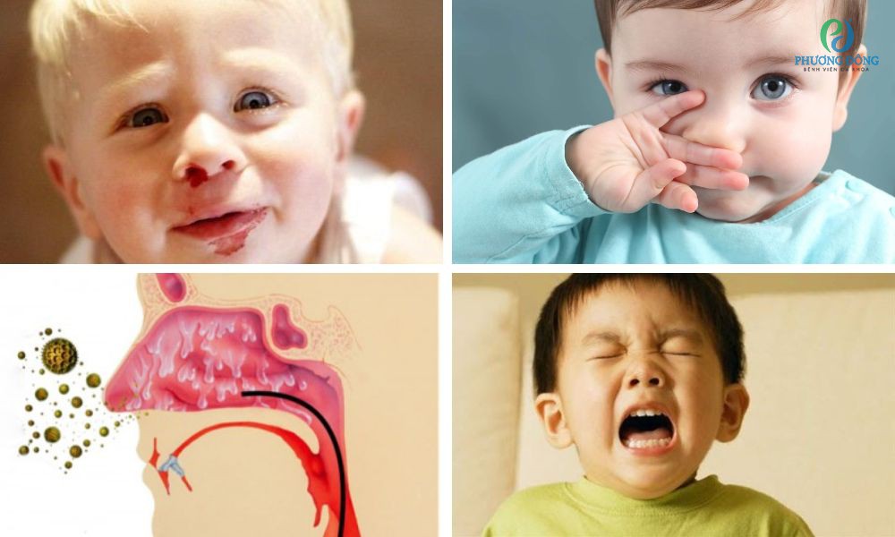 Thuốc Điều Trị Viêm Mũi Dị Ứng ở Trẻ Em: Hướng Dẫn Chi Tiết Thuốc Điều Trị Viêm Mũi Dị Ứng ở Trẻ Em: Hướng Dẫn Chi Tiết