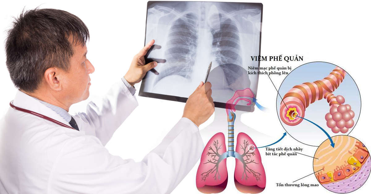 Điều trị viêm phế quản bằng bài thuốc dân gian hiệu quả Điều trị viêm phế quản bằng bài thuốc dân gian hiệu quả