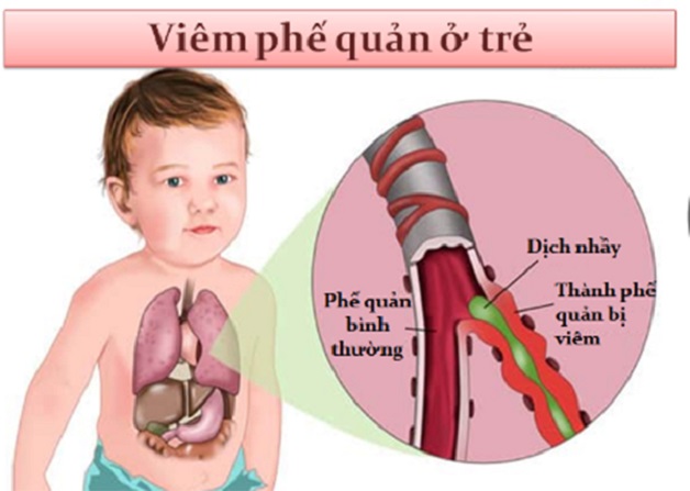 Trẻ Sơ Sinh Bị Viêm Phế Quản Uống Thuốc Gì: Hướng Dẫn Chuyên Sâu