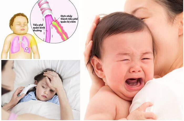 Chữa Viêm Phế Quản Ở Trẻ Em Bằng Thuốc Nam: Hướng Dẫn Chi Tiết