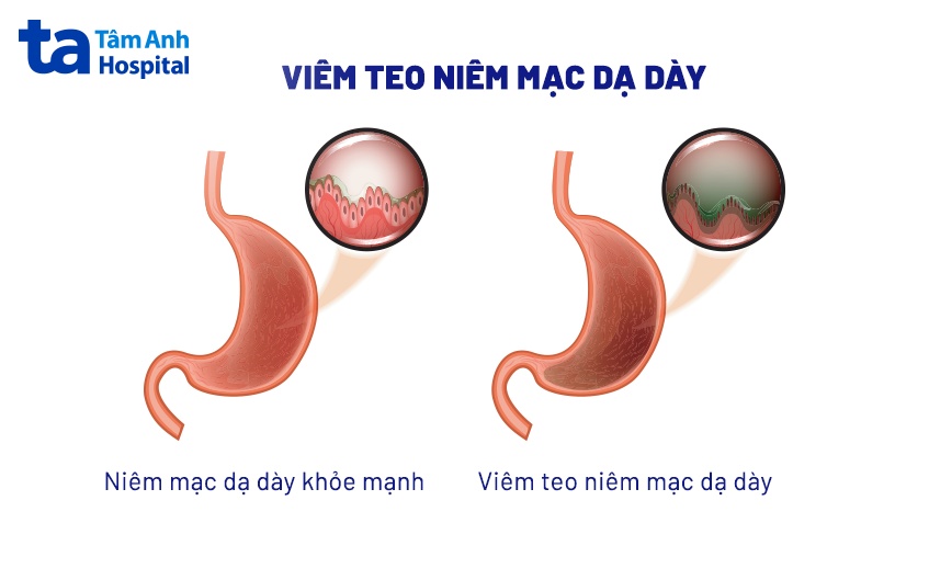 Chữa Bệnh Teo Niêm Mạc Dạ Dày Bằng Thuốc Nam Hiệu Quả và An Toàn