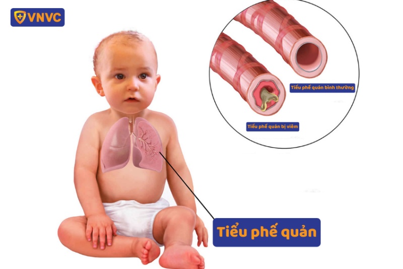 Trẻ Sơ Sinh Bị Viêm Phế Quản Uống Thuốc Gì: Hướng Dẫn Chuyên Sâu