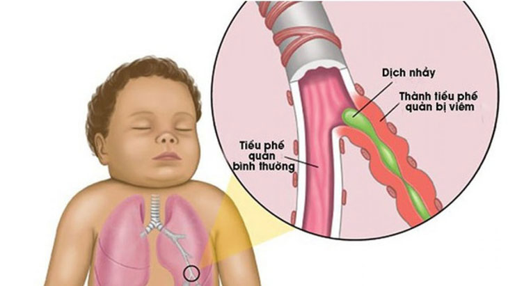 Chữa Viêm Phế Quản Ở Trẻ Em Bằng Thuốc Nam: Hướng Dẫn Chi Tiết Chữa Viêm Phế Quản Ở Trẻ Em Bằng Thuốc Nam: Hướng Dẫn Chi Tiết