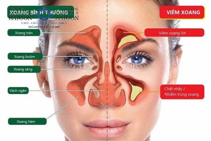 Viêm Xoang Có Lây Không? Giải Đáp Chi Tiết Từ Chuyên Gia