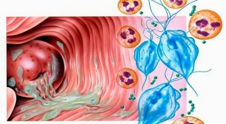 Điều Trị Viêm Âm Hộ Do Nhiễm Trùng Roi: Hướng Dẫn Chi Tiết và Hiệu Quả