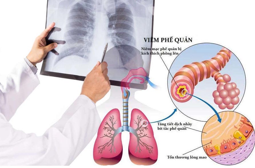 Điều trị viêm phế quản bằng bài thuốc dân gian hiệu quả Điều trị viêm phế quản bằng bài thuốc dân gian hiệu quả